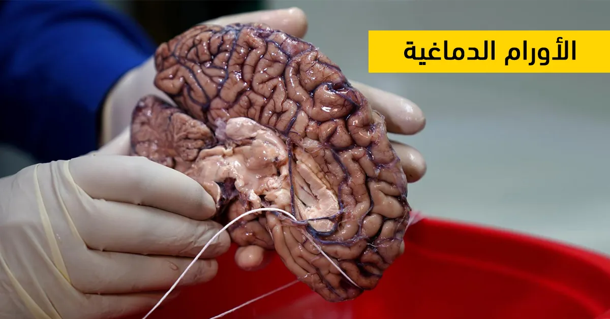 الأورام الدماغية